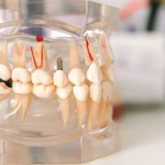 Jak długo trwa wstawienie zębów – leczenie implantologiczne